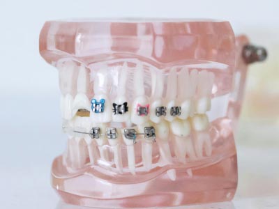 6 Common Mistakes to Avoid With Dental Braces in El Paso