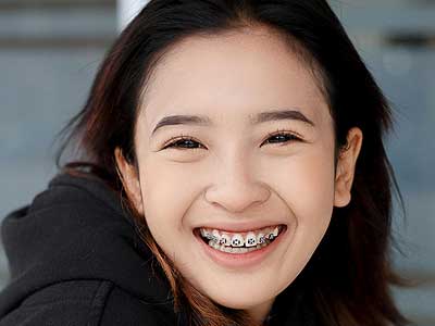 Dental Braces in El Paso: Transform Your Smile with Confidence